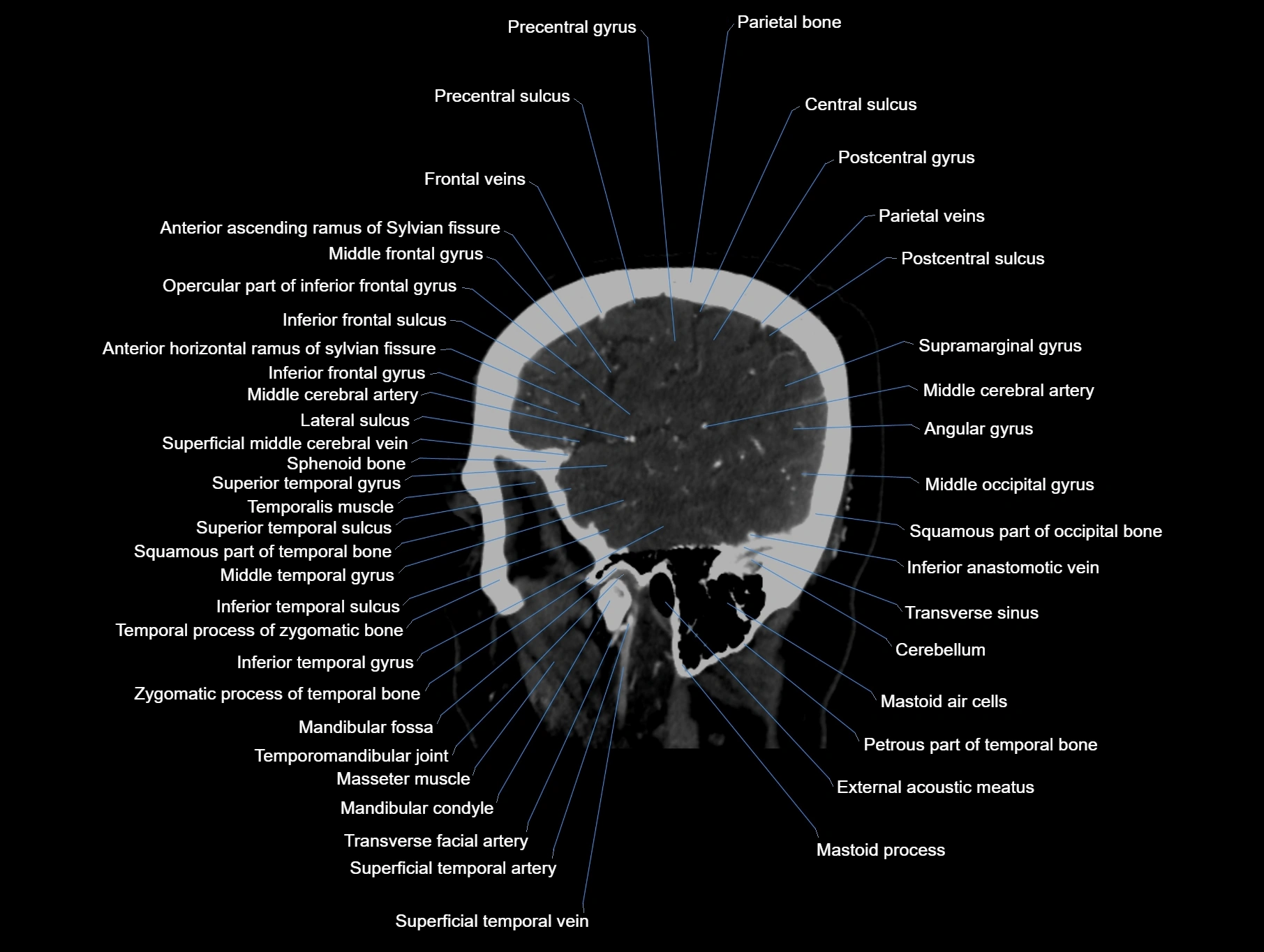 CT scan brain sagittal cross sectional anatomy image-img-00001-00014.webp